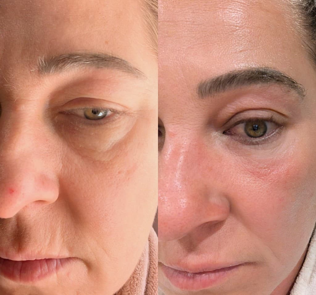 Eye Cream before and after 42 days