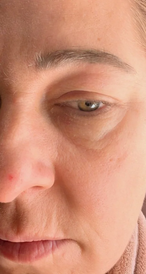 Under-eye area on day 0, before starting The Eye Cream