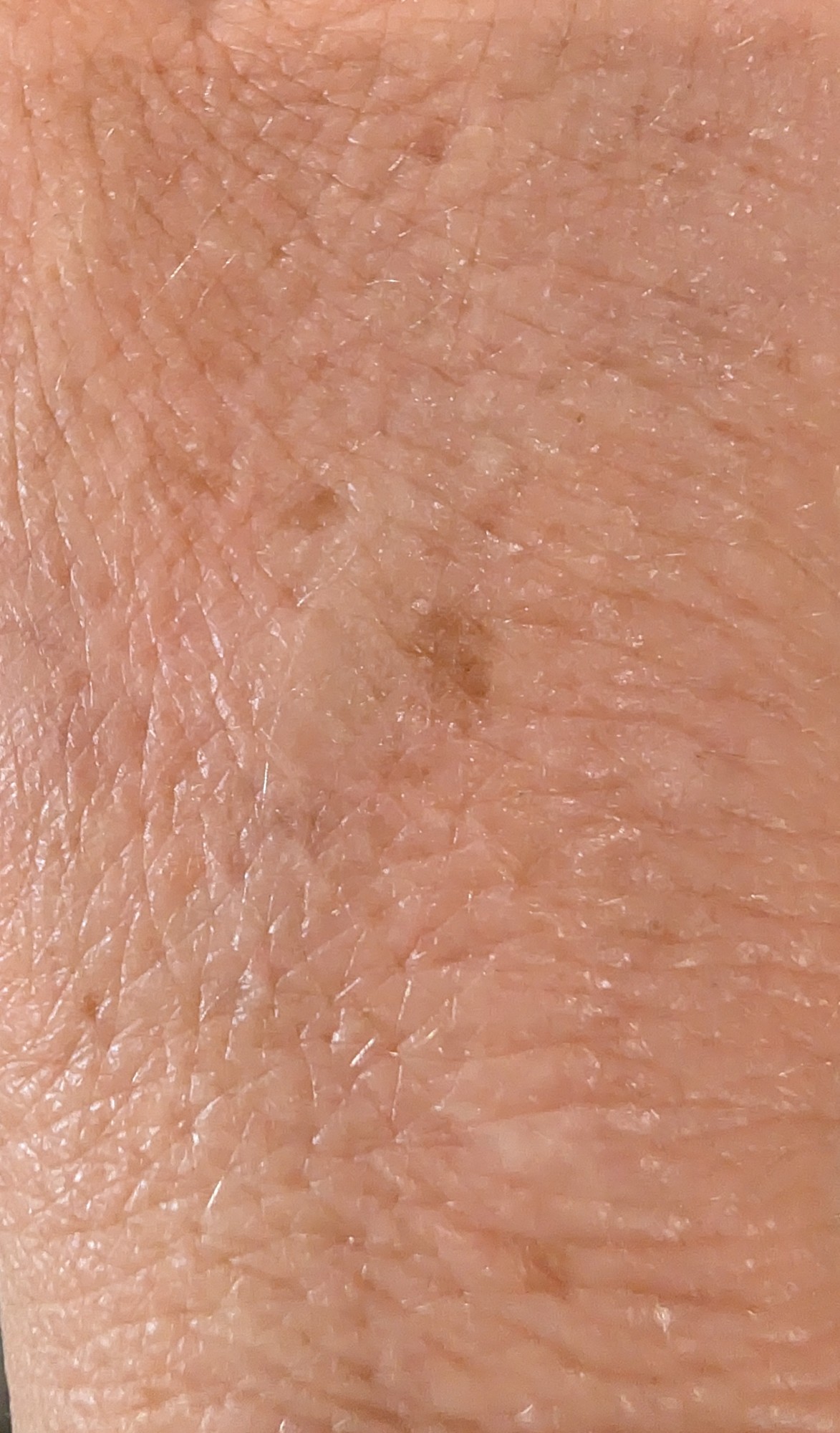 The same area of Marguerite's skin after two weeks with The Crème